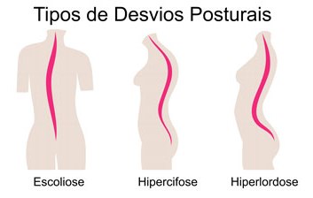 Reeducação Postural Global e a prevenção de alterações posturais